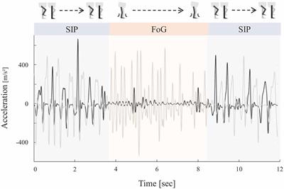 Combined Subthalamic and Nigral Stimulation Modulates Temporal Gait Coordination and Cortical Gait-Network Activity in Parkinson’s Disease